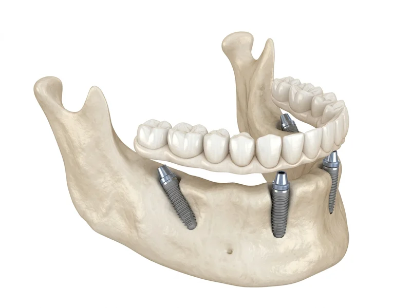 All-on-4® Treatment illustration