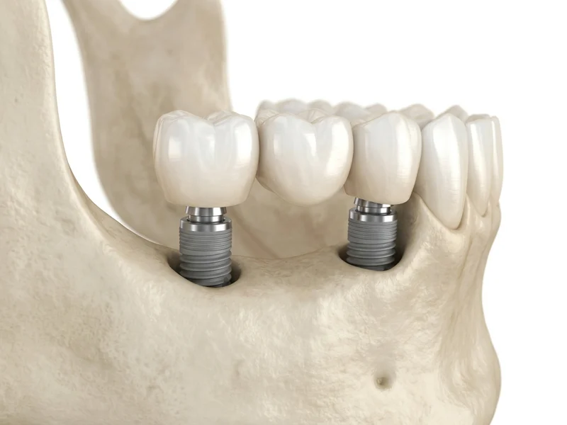 Fixed Implant Bridges illustration