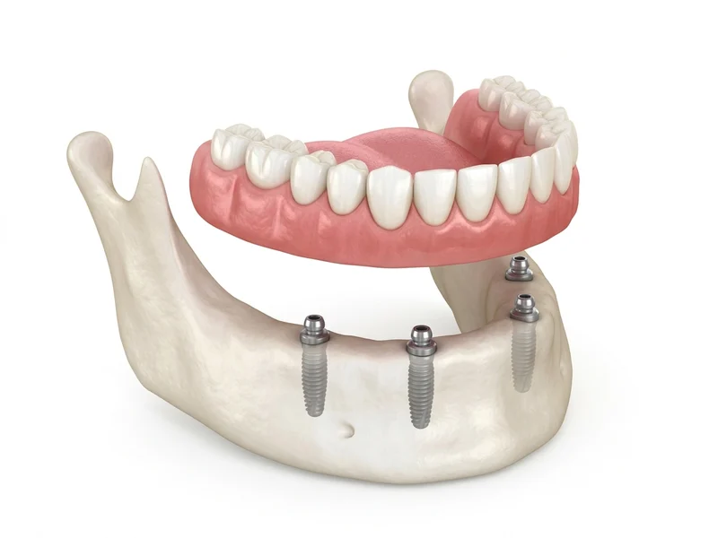 Removable Implant Dentures illustration
